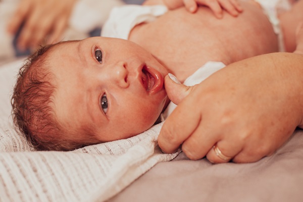Frenectomy: Ask A Pediatric Dentist About Newborn Lip And Tongue Tie